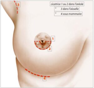 incisions cutanées pour prothèses mammaires