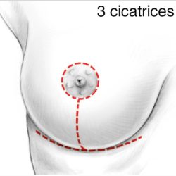 3 cicatrices sréduction sein