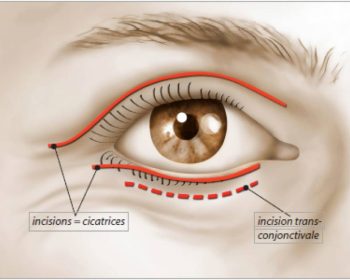 Blépharoplastie paupières