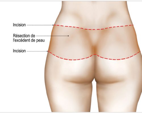 Incisions Bodylift recto