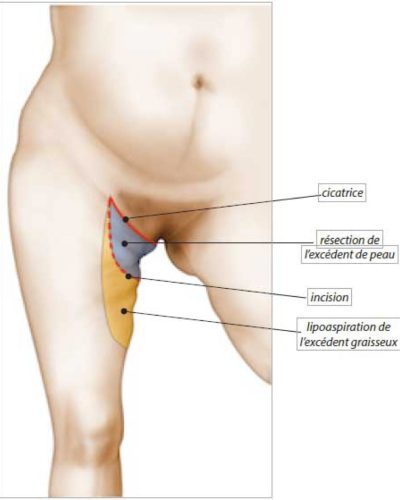 Lifting cuisses Technique horizontale pure