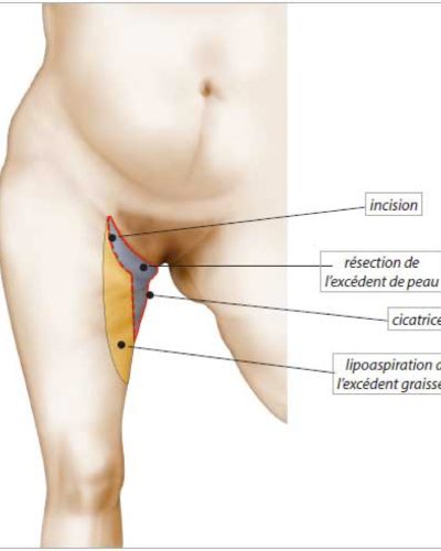 Lifting cuisses Technique mixte