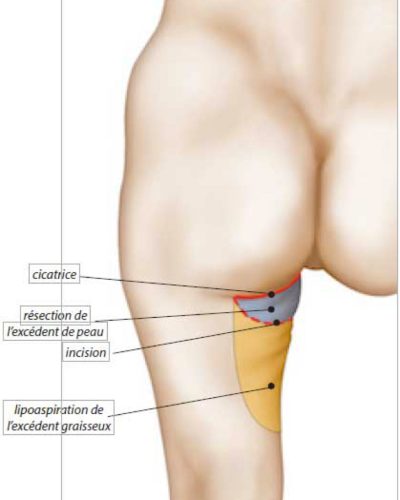 Lifting cuisses Technique verticale pure