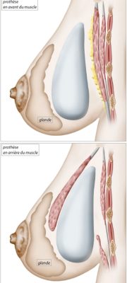 Mise en place des prothèses mammaires