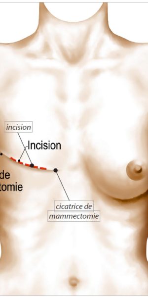 cicatrice de mastectomie