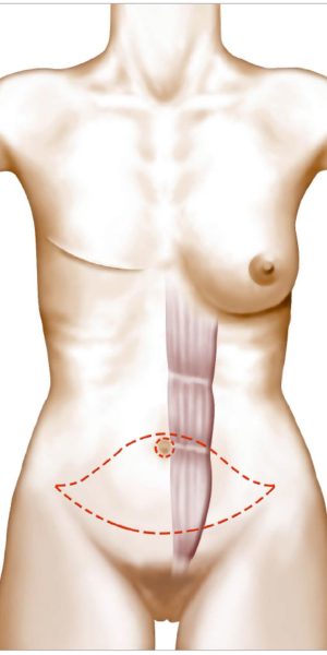 excès de peau et de graisse de la région abdominale sous ombilicale