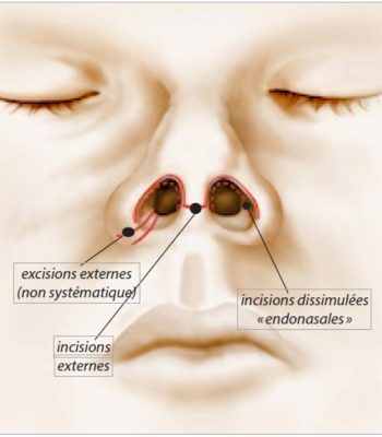 incisions rhinoplastie