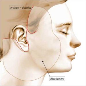 lifting cervico facial