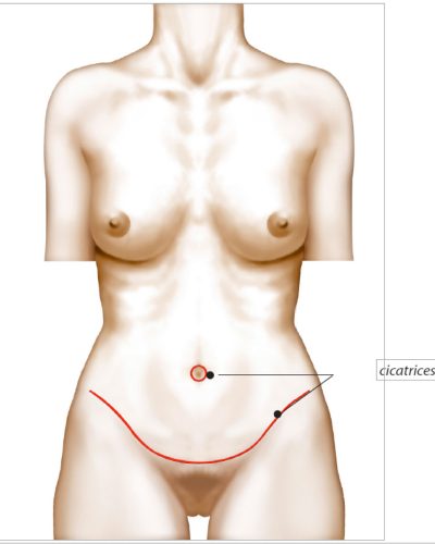 plastie abdominale cicatrices