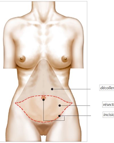 plastie abdominale étendue classique