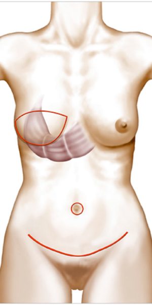 reconstituer le volume et les contours du sein